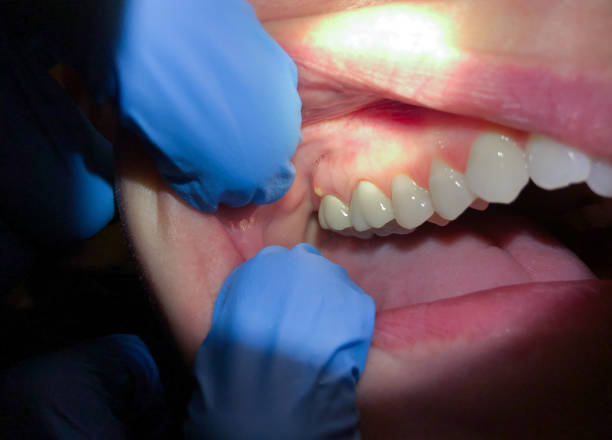 Best Emergency Tooth Extraction in Pearl Beach, MI