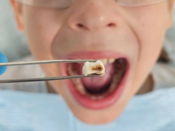 Best Urgent Care for Lost Fillings or Crowns in Pearl Beach, MI
